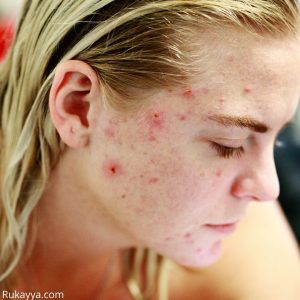 Acne are not symptoms of pregnancy and period the same